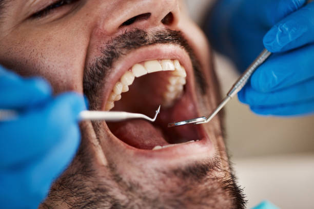 Best Emergency Dentist for Lost Fillings or Crowns in Laurel, VA